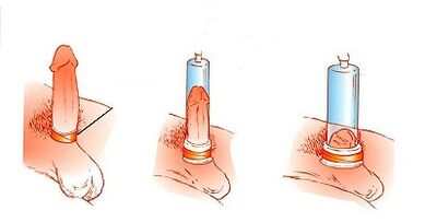 Prinsip pengoperasian pompa untuk meningkatkan penis