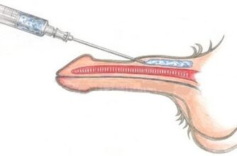 Cara memperbesar penis yang berbahaya dengan menggunakan suntikan Vaseline